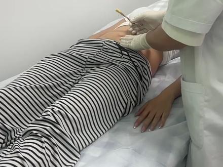埋线一年分享我的感受#针灸埋线 #逆袭 #女生