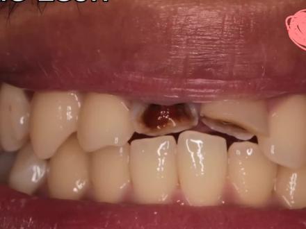 王子和乞丐,就差这两颗牙!德哥的前牙修复视频!#口腔健康 #牙医日常 #牙齿🦷 #牙冠