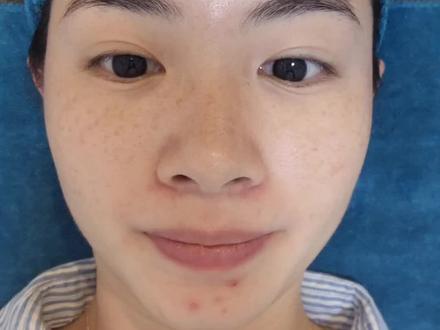记录超皮秒祛斑的第二次的第一天。皮肤新陈代谢周期一般为28天,今天左边脸颊和额头大颗的斑打了爆破。想祛斑的姐妹们先看看效果,我打前锋哈哈哈!☺️#雀斑 #黄褐斑 #袪斑 #超皮秒 #让我们一起变美