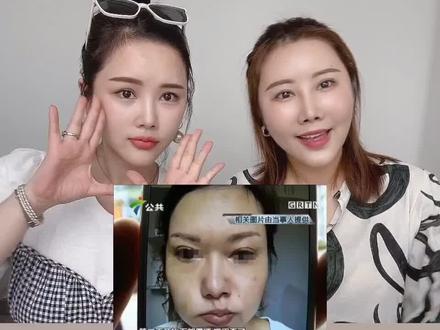 瘦脸针的后遗症#瘦脸