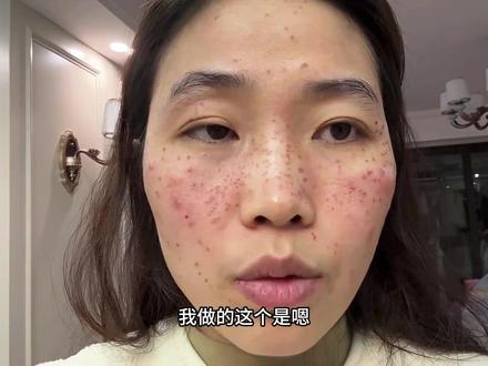 记录激光祛斑第一天,真的超级痛,视频最后有刚做完祛斑手术后的效果 #护肤 #变美 #祛斑的真实视频 #中视频伙伴计划 #皮肤