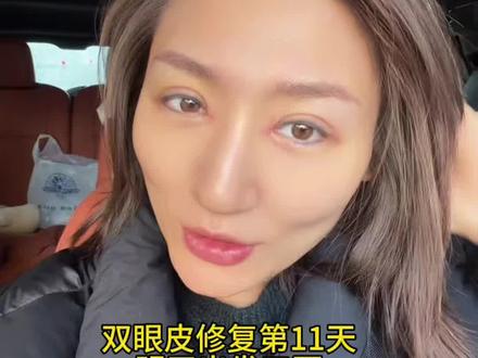 双眼皮修复第11天能见人了哈哈哈,明天出发三亚,今天去把给狗狗们洗剪吹一下,几个月看不到,想它们,晚上做了鸡蛋窜鲜肉,排骨炖豆角,还是在家吃舒服#vlog日常 #周末 #鸡蛋的神仙吃法