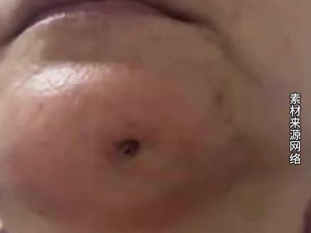 女子长期不管蛀牙,结果下巴被蛀出一个洞