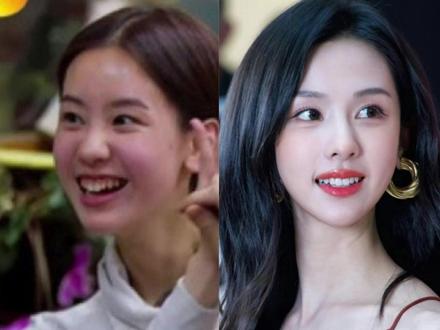 陈都灵的牙齿,如何矫正变美? 牙弓狭窄,颊廊很宽
我们来看陈都灵的牙,她就是我们很多很可爱的小女生都有的那种两颗小小的兔子牙。那我们看她的下半张脸会发现它是比较偏小量感的美女,她的整个脸非常小。
原来我们看她笑起来的时候,她的牙弓也是比较狭窄的。她笑起来两边的颊廊很宽,这样呢也会在视觉上加重了这两颗门牙突出来的牙弓,她很有可能是比较尖圆型的牙弓。那这种尖圆型的牙弓呢就会让人觉得笑起来比较小家碧玉一点。
扩弓,颊廊变小
那我们发现她可能是做了牙齿的矫正,通过牙齿矫正,可能是设计了一点点的扩弓。我们会发现她后面的牙齿牙弓宽度明显的增大了,两边颊廊的间隙就小了一些。这样呢我们看起来就会更协调一点,她的整个的牙弓的曲线和笑起来,微笑的弧度都会饱满了一些。
调整牙龈曲线
同时通过我们牙齿的调整,我们也会发现她的牙龈的曲线也比原来更协调了一点。原来呢有一些侧切牙的地方它比较靠里,所以我们就会觉得她这个地方的牙龈曲线稍微有一点高低不平。通过我们牙齿矫正了之后,她的牙龈的曲线也协调了很多。
#牙齿拥挤 #牙齿不齐 #九院正畸 #上海九院 #上海牙齿矫正