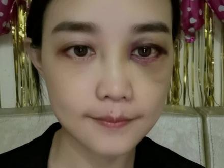 眼袋术后第三天分享#整形 #眼袋