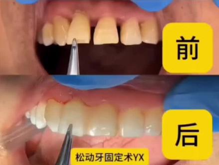 接上一个松牙固定,好多人问怎么固定的松动牙?过程来啦!