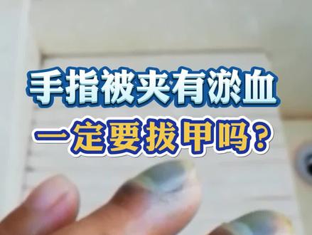 手指被夹的痛谁懂,留下淤血一定要拔甲吗?这样处理就可以#皮肤 #科普 #指甲 #淤血