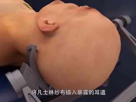 揭秘开颅手术全过程#开颅 #手术#神经外科