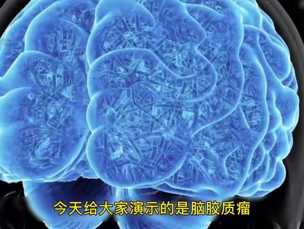 胶质瘤的发生原因#神经外科 #胶质瘤 #医学科普知识
