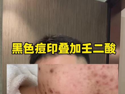 黑色痘印,在传明酸叠加壬二酸飞速邪修,但别买贵59两支免费试 #希川科颜壬二酸#壬二酸#希川科颜#黑痘印