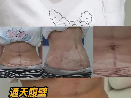 生育、剖腹产给无数女性造成了困扰,挨了一刀又一刀,致敬女性 同胞!#通天腹壁疤痕修复 #谢超医生 #医学科普 #腹壁整形 #腹壁成型