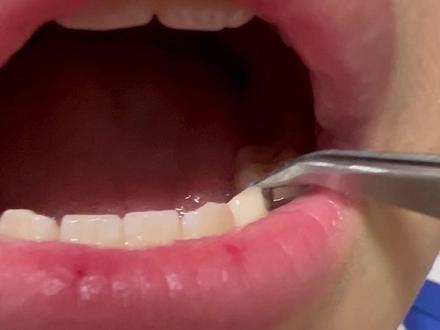 胆小勿看!蛀牙里真的有虫子吗?放到显微镜下居然会动……# 显微镜 # 蛀牙 # 内容过于真实#usmile笑容加