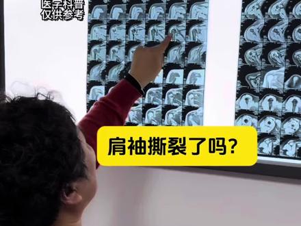 肩袖撕裂了吗? #影像科医生 #核磁共振 #肩关节疼痛 #肩周炎 #误诊