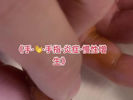 手指容易受伤 容易出现局部慢性炎症反复不好 需要认真处理 一旦感染处理有些很麻烦#手#手指#炎症#打封闭#感染#皮肤#疼痛#指头炎#医学科普#医学知识#科普#医学#健康#健康最重要#抖音#抖音小助手#dou#手外科#武汉协和医院#武汉协和医院李涛#关节#滑膜炎#康复