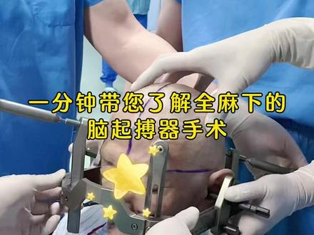 一分钟带你了解脑起搏器手术,看完秒懂#医学科普 #帕金森