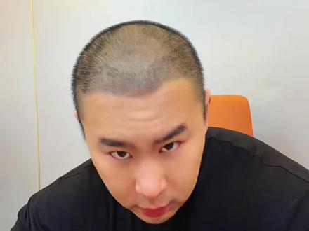 植发还是比较遭罪的,有想法的一定要考虑好#植发 #麦蔻 #健身圈