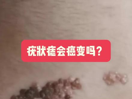 疣状痣会癌变吗#医学知识科普 #疣状痣 #皮肤外科
