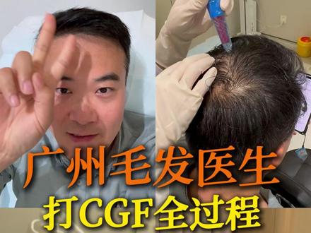 40+毛发医生打CGF生发针的一天vlog #生发针#CGF#脱发#vlog#抖出健康知识宝藏