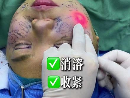 1470超微光面部打薄收紧 #面部提升 #馒化 #抗衰 #法令纹 #变美