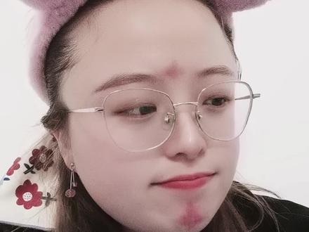 #长治阴疙瘩 身体不舒服是最难受的事了,头疼难以承受就放放血吧,先扎破,然后挤,就会成这个样子,效果是真的好。