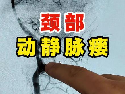 一例颈部的动静脉瘘 #动静脉瘘 #医学科普 #教学视频 #抖出健康知识宝藏 #健康科普破圈计划