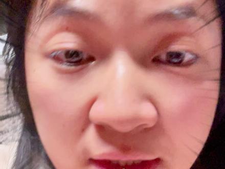 半夜,拿蜱虫的人排起了长❗️❗️ 在小区里被蜱虫咬了!!!
呦呦放学回家前在小区儿童游乐区玩了十几分钟,就被蜱虫咬了!
-----
⚠️被蜱虫咬不是所有医院都能处理⚠️
我们就近先去中医院儿科,说治不了让去急诊,急诊用酒精棉敷上,又嘱咐我们去市二院(钟阜路)。
-----
开了半个多小时车到市二院,蜱虫没有自主掉落,只能请医生那小剪子、针拔除了,去掉一小块肉,这也算手术哦!
医生说,有的幼童不配合医生处理,还需要到儿童医院打麻醉❗️❗️❗️
-----
蜱虫取出后如何观察
三天后再到市二院查血,查是否感染布尼亚病毒+一个月内每周抽血一次+一个月内如果出现发烧等症状,就近医院查血常规,发现血小板降低,则需立即就医
…………
这个视频,我絮絮叨叨这么多话,是希望提醒大家,今年蜱虫真的太狠了,不要觉得离自己很远!小区、公园、商场的花坛边都不要停留!!!户外要喷药!
----
#南京蜱虫 #蜱虫 #白马 #亲子 #虹悦城