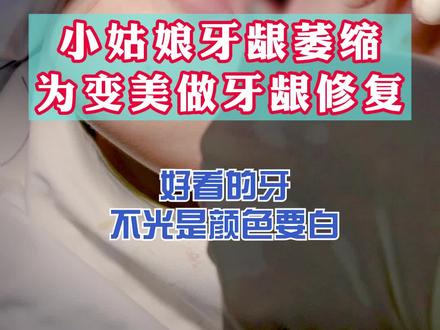 小姑娘牙龈萎缩,为变美做牙龈修复#口腔健康 #口腔科普 #小荷门诊爱牙
