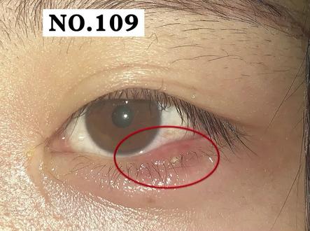 长针眼是因为看了不该看的东西?#针眼麦粒肿 #眼睛 #医学科普