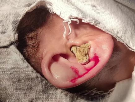 我很想知道当我的名字划过你的耳朵,你的脑海中会浮现什么#耳廓软骨囊肿手术切除#手术室日常