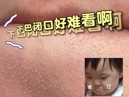 下巴密密麻麻的小白点,不是#闭口 ,可以这样处理#科普 #皮脂腺 #爱美