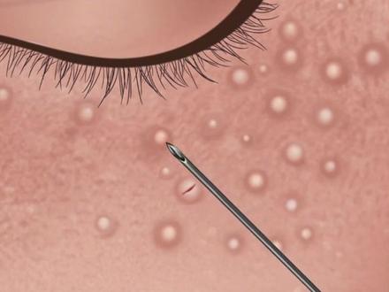 眼睑部位长#脂肪粒是因为涂眼霜涂眼霜?教你一招在家简单处理!#变美 #护肤 #医学科普 #变美小技巧