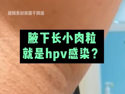 腋下长了小肉粒,摸上去软软的,可能不是#hpv 感染,可以这样处理#医学科普 #皮肤 #皮赘 #知识分享