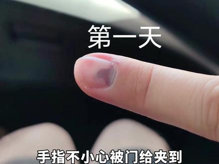 手被门夹了怎么办?医生教你分情况处理!#健康科普 #赵医生皮科问题深度说 #生活小常识 #急救 #抖出健康知识宝藏