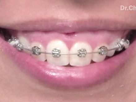 #牙齿#口腔 兔子牙该如何矫正