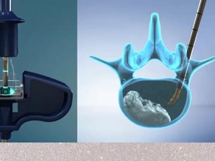 骨水泥手术#科普 #知识科普 #骨科 #