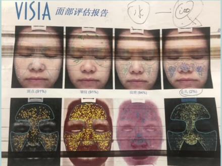 怎么样看懂ViSIA皮肤检测结果呢?#肌肤问题 #皮肤管理 #美容护肤小知识