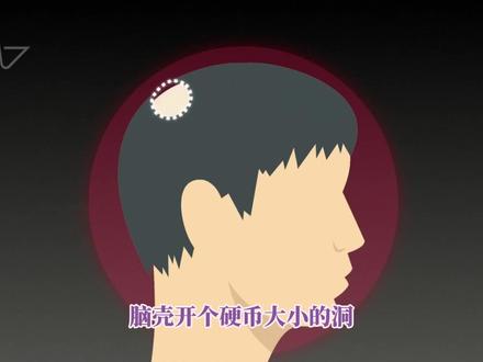 马斯克要量产脑机接口?赛博人类照进现实 #马斯克 #脑机接口 #人工智能 #AI #科技