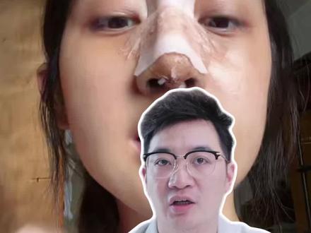 油皮隆鼻护理全教程! #抖出健康知识宝藏 #医疗健康创作训练营 #油皮 #隆鼻 #鼻综合