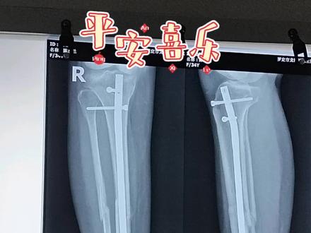历时4个多月,长骨痂了 @影子