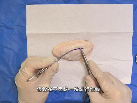 鸡翅模拟埋线双眼皮 #双眼皮 #医学小知识 #有趣的知识又增长了