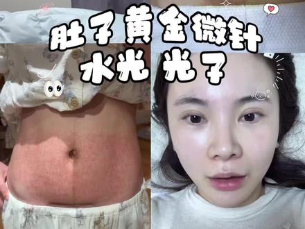 黄金微针治疗妊娠纹流程~
同时做了光子+水光针。
敷麻药后打光子,然后黄金微针,最后涂抹水光针。
疼痛感非常低(相比于脸)。
回家后结痂前涂抹生长因子。
#妊娠纹 #黄金微针