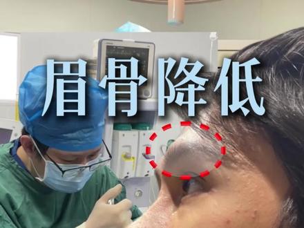 帅气男模眉骨高,眉压眼不上镜! #高眉骨 #眉压眼 #眉骨降低 #轮廓 #杜本军