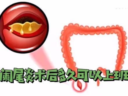 阑尾术后多久可以上班#创作灵感#科普#阑尾炎#医学#上班#术后