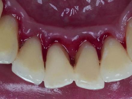 吸了20多年的yan,牙齿会变得有多脏?清洗过程太解压了 #保护牙齿 #口腔健康 #洗牙 #牙齿 #牙齿正畸