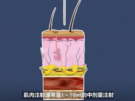 小时候风靡的屁股针,为什么现在很少见了?
