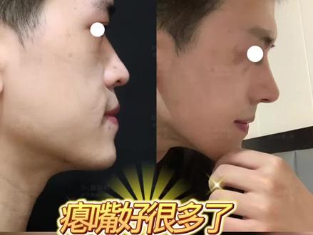 男生拉出面中后,不瘪嘴了
#男生鼻子 #拉面中 #男生do鼻 #上海鼻子 #面中凹陷