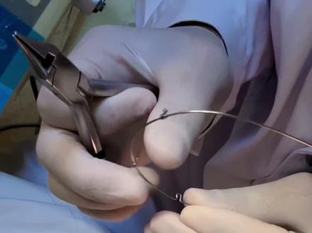 视频前10秒一定要看仔细哦,前牙反颌纠正后经常会出现咬合创伤,停止曲是快速改善创伤的方法之一。
#咬合创伤 #正畸 #牙齿矫正 #停止曲 #牙套