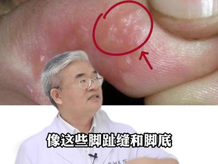 这种脚上长小水泡的情况你有吗?可以试试这样做#医学科普#脚气#足癣#特比萘芬喷雾