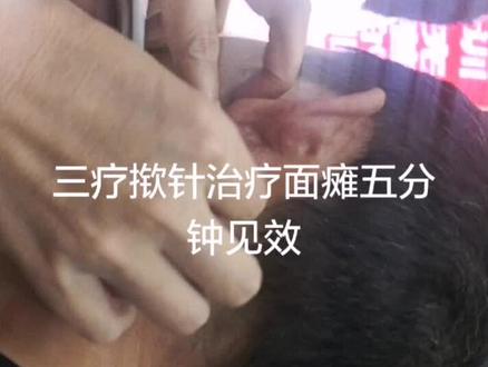 三疗揿针治面瘫,下针后五分钟见效。