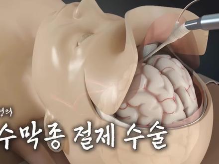 脑袋正中间长肿瘤怎么手术切除,3D演示。。
